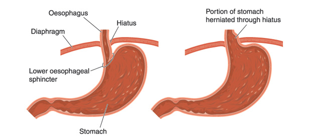 Reflux